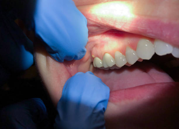 Best Emergency Wisdom Tooth Extraction in Madison, GA