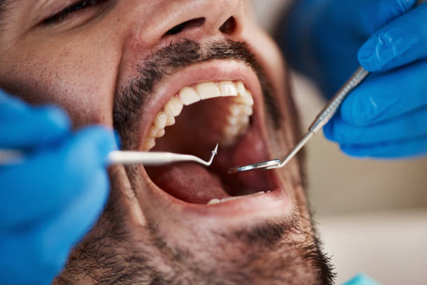 Best Knocked-Out Tooth (Avulsed Tooth) Treatment in Madison, GA