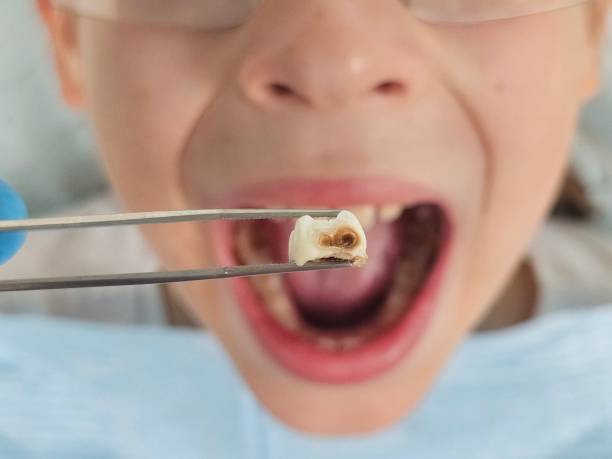 Best Emergency Treatment for Oral Infections in Madison, GA